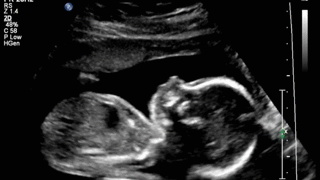 Ultrasound at 12 weeks